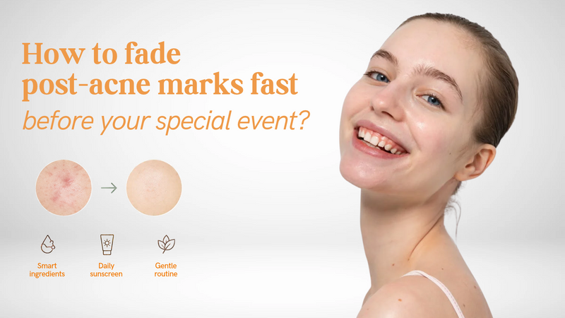 How to fade post-acne marks fast before your special event?