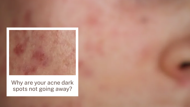 WHY ARE YOUR ACNE DARK SPOTS NOT GOING AWAY? FIND OUT WHY