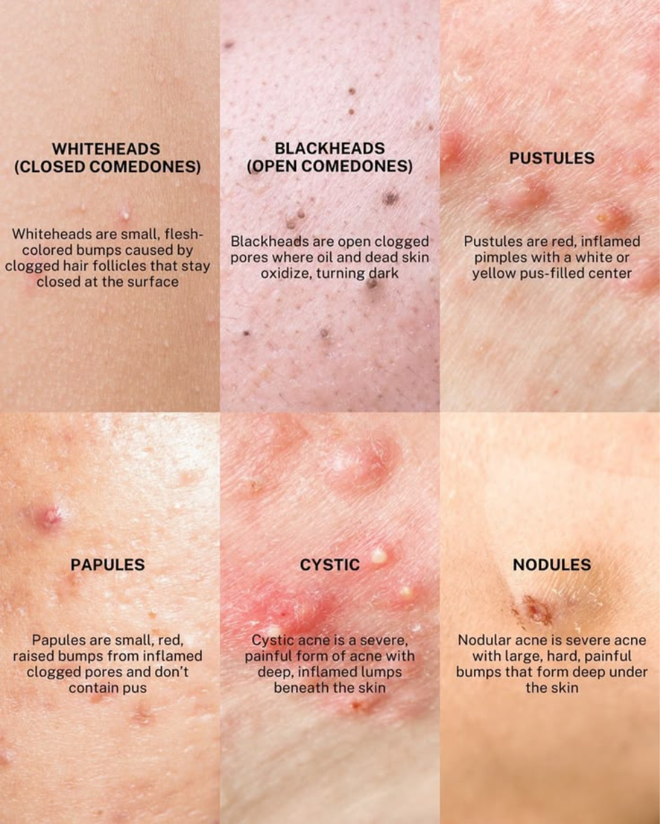 TYPES OF ACNE BLEMISHES: WHAT’S THAT BUMP ON YOUR SKIN?