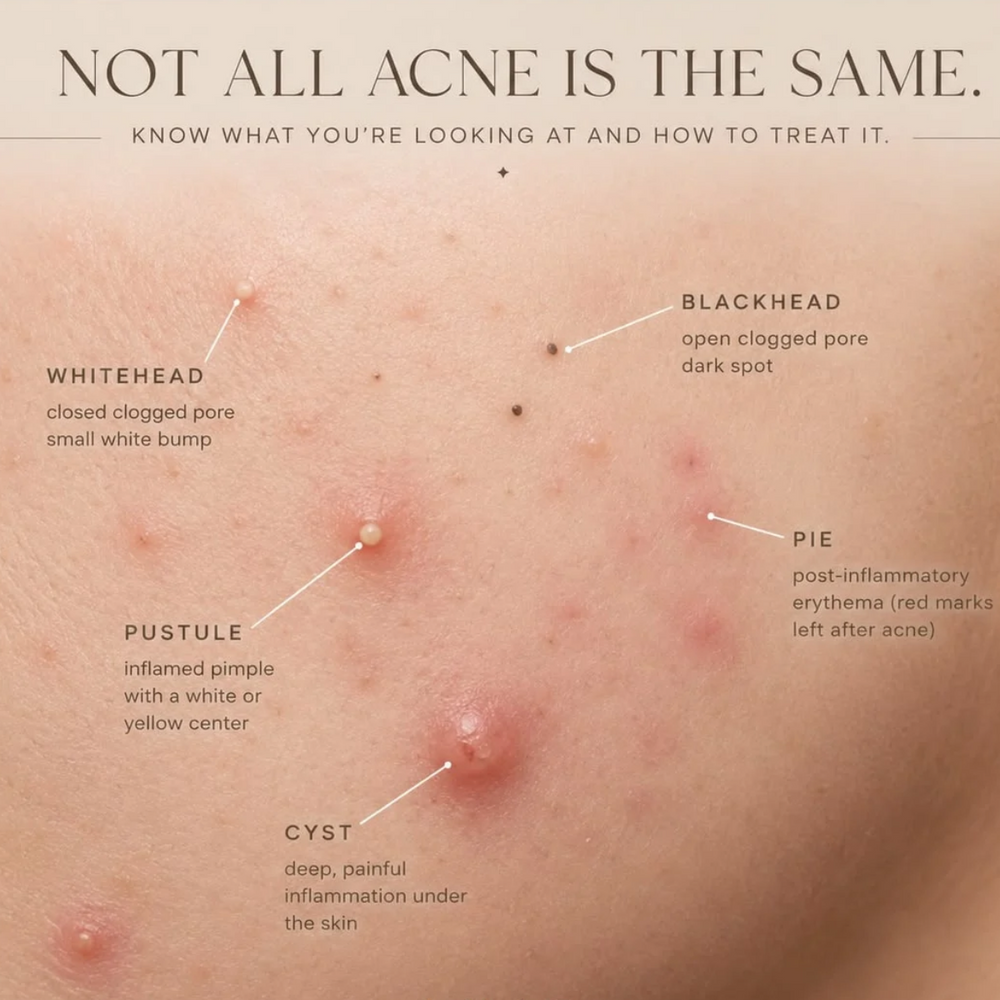 Spot the top 3 blemish types